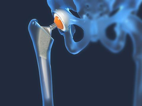 Photo: Hip Replacement